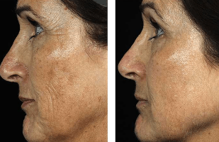 Antes y después del rejuvenecimiento facial fraccionado