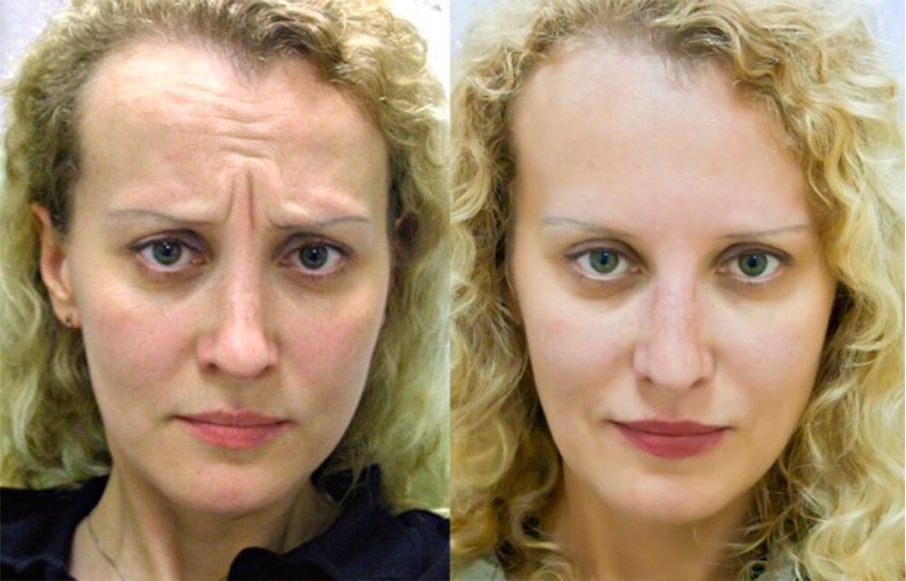 antes y después de usar el masajeador para el rejuvenecimiento ltza foto 1
