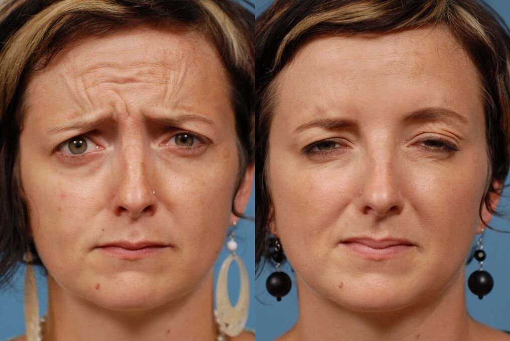 antes y después de usar el masajeador para el rejuvenecimiento ltza foto 2