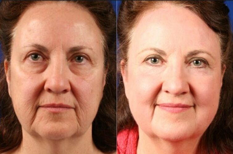antes y después de usar el masajeador para el rejuvenecimiento ltza photo 6