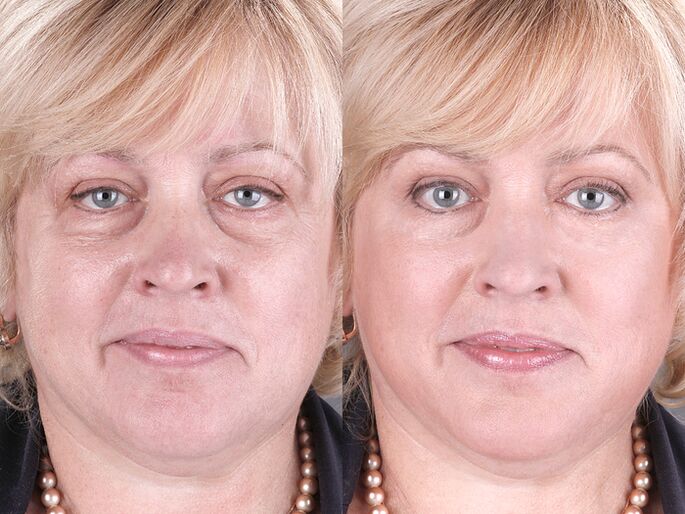 antes y después de usar el masajeador para rejuvenecer ltza foto 3
