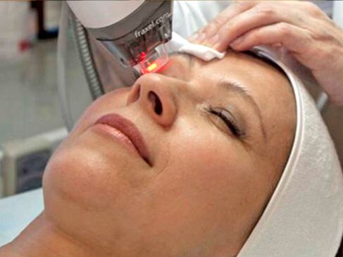 Rejuvenecimiento láser de la piel alrededor de los ojos