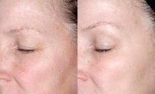 Rejuvenecimiento de la piel del contorno de ojos fotos antes y después