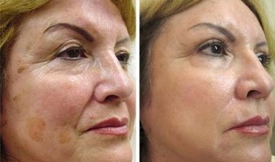 rejuvenecimiento fraccional de la piel fotos antes y después